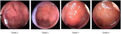 MIB-ANet: A novel multi-scale deep network for nasal endoscopy-based adenoid hypertrophy grading